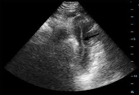 Looking for online definition of sternal notch in the medical dictionary? Cureus Point Of Care Ultrasound Diagnosis Of Type B Aortic Dissection On The Suprasternal Notch View