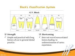 International Caries Detection And Assessment System Icdas