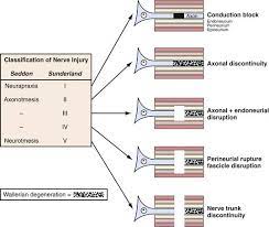 Understanding nerve injury classification is essential for prognostic value clinically. Image Result For Sunderland Classification Nerve Physiology Peripheral Nerve