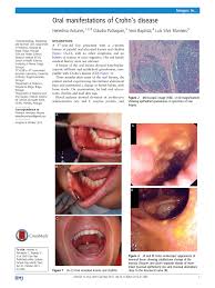 Pdf Oral Manifestations Of Crohn S Disease