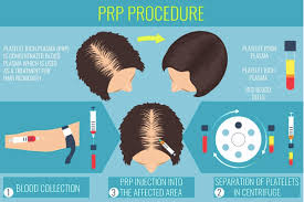 The dermacare institute in austria carries out hair loss treatment with prp just as quickly and efficiently. Which Hospital Clinic Is Authentic And Cost Effective For Prp Plasma Rich Platelet Hair Growth Treatment In Bangalore Chennai Quora