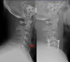 We did not find results for: Flexion Teardrop Fracture Wikipedia