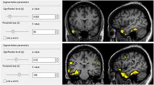 There are many health services provided at ezcare medical clinic. Frontiers Epileptogenic Zone Localization With 18fdg Pet Using A New Dynamic Parametric Analysis Neurology