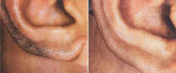 Home laser hair removal is a technology for removing body hair by exposure to precise lasers. Facial Hair Removal Philadelphia For Women And Men Main Line Pa