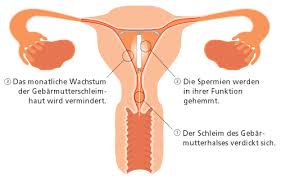 Der begriff iud ist bekannt geworden in verbindung mit der kupferspirale und der kupferkette. Hormonspirale Dr Med Michael Singer Gyne