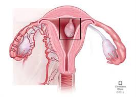 Other types of cancer can form in the uterus, including uterine sarcoma, but they are much less common than endometrial cancer. Uterine Polyps Causes Symptoms Diagnosis Treatment