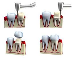 We did not find results for: Crowns Bridges Inglewood Tooth Replacement And Restorations