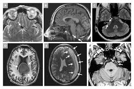 Image result for Incidental Imaging Finding