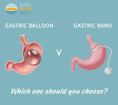Pin On Gastric Banding