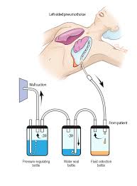 Chest Tube Complications Psnet