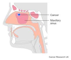 Image result for Maxillary Sinus