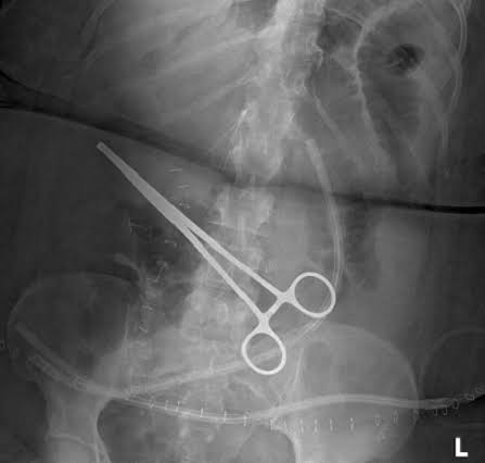 An example of retained surgical clamp (ntRSFB). Clinical presentation... |  Download Scientific Diagram
