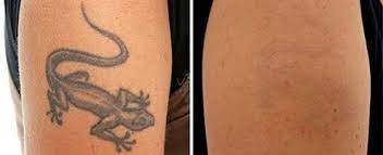 Laser light breaks the pigment particles into tiny parts which are removed as toxins through the body's lymphatic system. Laser Tattoo Removal Home Facebook
