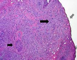 He said that most lumps with circumscribed edges are benign, but he wants to make sure. Surgical Margins In Breast Conservation Sciencedirect