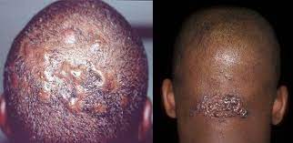When this happens, the way the. Ingrown Hair On Scalp Is No Abnormal Skin Condition Especially For Men Who Shave Their Heads On A Reg Ingrown Hair On Scalp Ingrown Hair Treatment Ingrown Hair