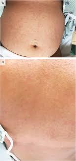 Most cases have no symptoms, but when present they are usually mild and can resemble dengue fever. Cutaneous Eruption In A U S Woman With Locally Acquired Zika Virus Infection Nejm