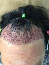 Each year, millions of men and women experience hair loss which. Dr Shah Hair Clinic In Subang Jaya Malaysia Read 4 Reviews