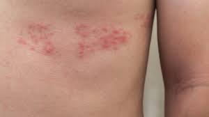 Symptoms typically start with pain along the affected. Herpes Zoster Shingles