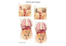 A biopsy is when a doctor removes tissue right from your ovary and examines it in a lab to look for cancerous. Appropriate Evidence Based Triage Is Vital To Outcomes In Advanced Epithelial Ovarian Cancer Mayo Clinic