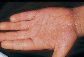 Allergy Skin Disorders Reactions Rashes And Treatments