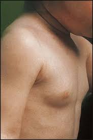 Image result for Precocious Puberty