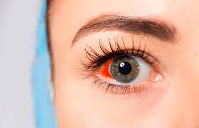 Geplatzte Ader Im Auge Wie Gefahrlich Ist Es
