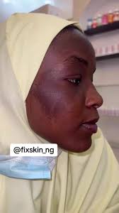 Effective Sunburn Treatment and Skin Care Routine