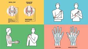 What is the difference between rheumatoid arthritis and osteoarthritis? What Is Rheumatoid Arthritis Symptoms Causes Diagnosis Treatment And Prevention Everyday Health