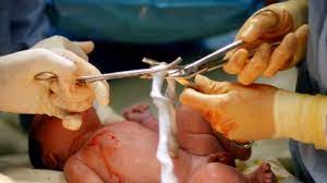 Cut Umbilical Cord