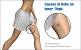 Women S Female Groin Lump Pictures