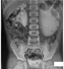 Image result for Intravenous Pyelogram