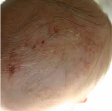 Image result for white scabs on the head in children