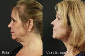 May 11, 2017 · ultherapy procedure your provider, usually a physician or laser technician, will clean the areas they plan to work on of any oil or residue and apply an ultrasound gel. Ultherapy North York Cosmetic Clinic