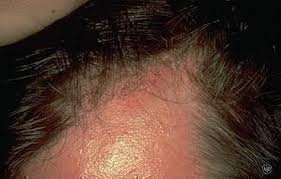 It is typically caused by the overproduction of oil in the skin. Is Seborrheic Dermatitis Hair Loss Permanent Dr Yu S Formula Natural Traditional Chinese Medicine For Hair Loss Dr Yu S Formula
