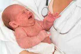 Nearly 70 doctors in NJ sign letter urging vaccines amid outbreak