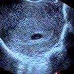 ultrasonda bebek gebelik kesesi ne zaman gorulur bebek