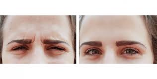 Curious about botox or dysport? How To Make Botox Last Longer Columbia Skin Clinic