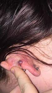 Piercing Bump Turned Purple Please Help Piercingadvice
