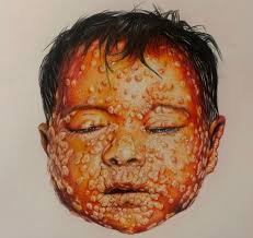 Following description of Smallpox in 'The Speckled Monster' by Jennifer Lee  Carrell (illustrations my own): 'In the worst case, purple spots and  convulsions, bloody urine, or no urine, or involuntary unstoppable urine;