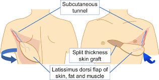Image result for Open Pneumothorax