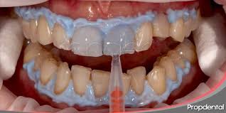 Quemadura En La Encia Por Blanqueamiento Dental