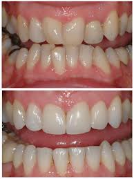 Check spelling or type a new query. How Do Braces Straighten Crooked Teeth Masri Orthodontics