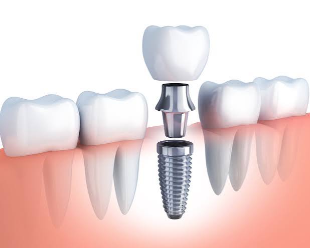 What Are Dental Implants? | Advantages of Dental Implants