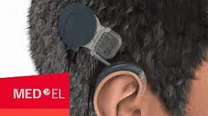 How Do Cochlear Implants Work The Synchrony Cochlear Implant Med El Youtube