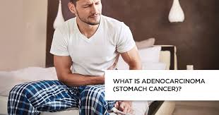 Test your knowledge about how medical cannabis is grown, its effects, and the different. What Is Stomach Cancer Symptoms Causes And Risk Factor