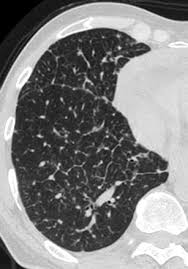 Image result for septal pattern