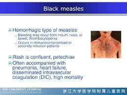 Meaning of branny desquamation medical term. Ppt Fever And Rash Powerpoint Presentation Free Download Id 9630367
