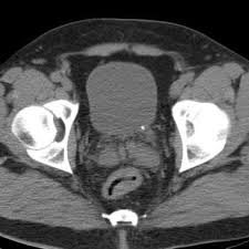 Image result for Nephrolithiasis Imaging