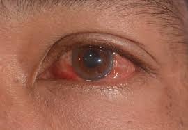 Bindehautentzündung behandlung und symptome title=viral bindehautentzündung behandlung. Virale Bindehautentzundung Wirksame Behandlung Area Oftalmologica