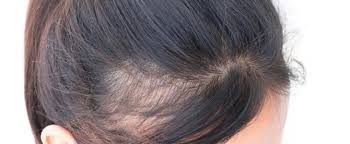 Research has shown that hair loss can be reduced with lysine supplementation 6 ideal food sources for lysine include fish (especially salmon, sardines and cod), dairy products, poultry, red meat, pork, legumes, nuts, spirulina and pulses. Solutions To Hair Thinning Bobbie J Rae Home Encouraging Words